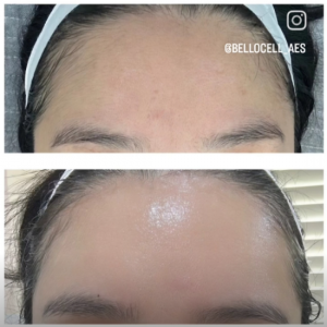 벨로셀에스테틱