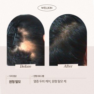 [서울 강남] 웰킨두피탈모센터 신사점